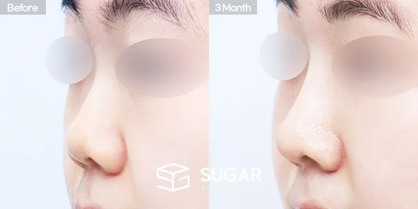 슈가성형외과 첫) 콧대 + 코끝 + 귀연골 + 복코 + 짧은코 + 매부리 전후사진 - 45도 수술 전후 비교