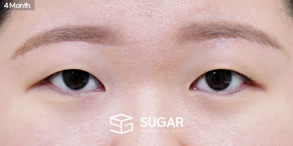 슈가성형외과 첫) 눈썹하거상술 + 눈 두덩이 지방 제거 전후사진 - 수술 후