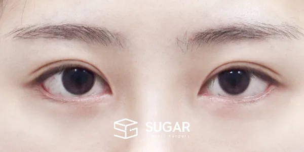 슈가성형외과 첫) 절개 + 윗트임 + 뒤밑트임 전후사진 - 수술 후