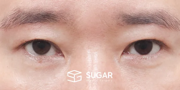 슈가성형외과 첫) 눈썹 거상 + 자연유착 + 눈 밑 지방 재배치 + 뒤밑트임 전후사진 - 수술 후