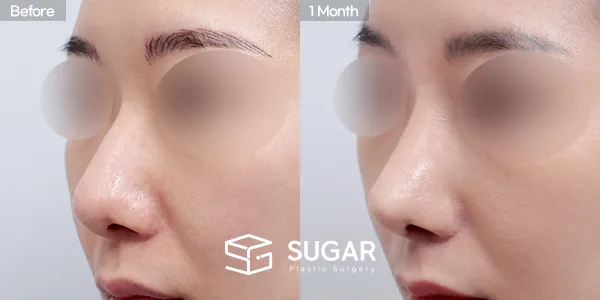 슈가성형외과 첫) 무보형물+복코+비중격연장+만곡증교정+귀연골+비중격+귀근막 전후사진 - 45도 수술 전후 비교