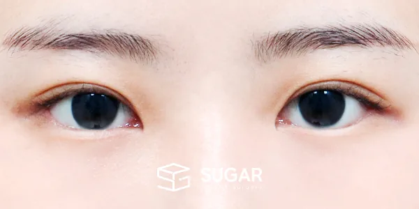 슈가성형외과 첫) 눈밑지방재배치 + 뒤밑트임 전후사진 - 수술 후