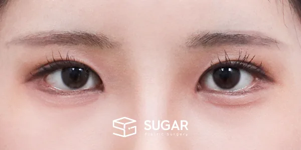 슈가성형외과 첫) 자연유착 + 눈매교정 + 윗트임 + 뒤밑트임 전후사진 - 수술 후