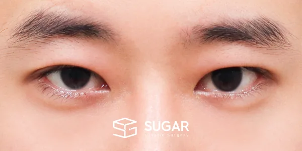 슈가성형외과 첫) 자연유착 + 눈매교정 + 뒤밑트임 전후사진 - 수술 후