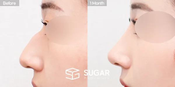 슈가성형외과 첫) 콧대 + 코끝 + 매부리코 + 휜코 + 절골 전후사진 - 측면 수술 전후 비교
