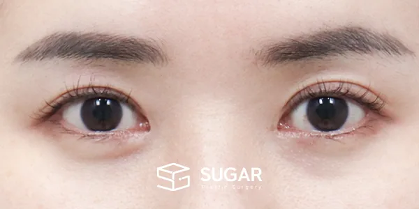 슈가성형외과 첫) 절개 + 뒤밑트임 전후사진 - 수술 전