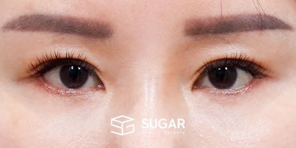 슈가성형외과 첫) 뒤밑트임 전후사진 - 수술 후