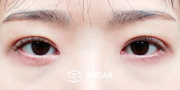 슈가성형외과 재) 재수술 + 절개 + 눈매교정 전후사진 - 수술 후