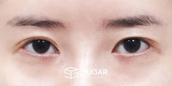슈가성형외과 재) 재수술 + 절개 + 뒤밑트임 전후사진 - 수술 전