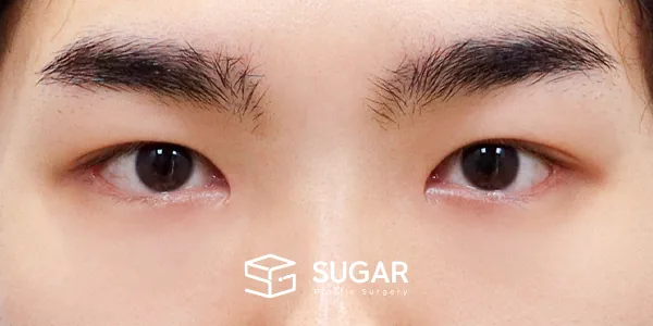 슈가성형외과 첫) 자연유착 + 눈매교정 + 앞트임 + 뒤밑트임 전후사진 - 수술 후