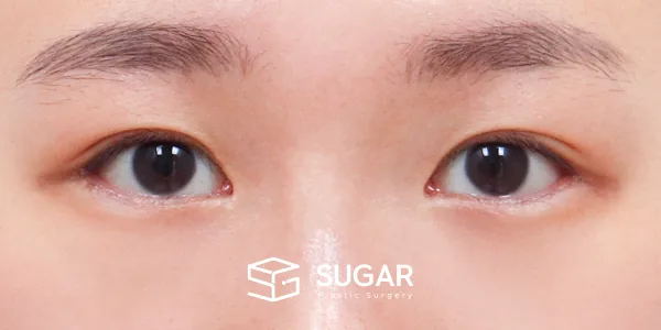 슈가성형외과 첫) 뒤밑트임 전후사진 - 수술 후