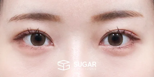 슈가성형외과 재) 재수술 + 자연유착 + 눈매교정 + 윗트임 전후사진 - 수술 후