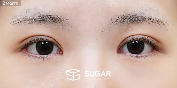 슈가성형외과 첫) 자연유착 + 눈매교정 + 앞트임 + 윗트임 + 뒤밑트임 전후사진 - 수술 후