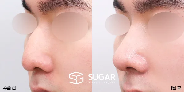 슈가성형외과 첫) 무보형물 + 매부리 + 절골 + 귀 뒤 근막 + 비중격 + 귀연골 전후사진 - 45도 수술 전후 비교