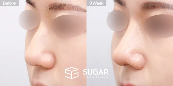 슈가성형외과 첫) 무보형물 + 비중격연골 + 귀연골 + 매부리 + 복코 + 귀 뒤 근막 전후사진 - 45도 수술 전후 비교