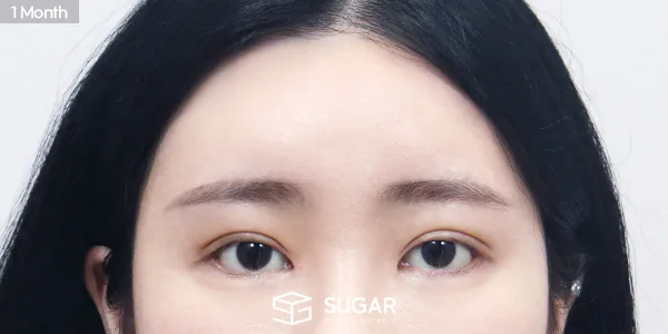 슈가성형외과 재) 자연유착 재수술 + 윗트임 + 뒤밑트임 + 이마거상 전후사진 - 수술 후
