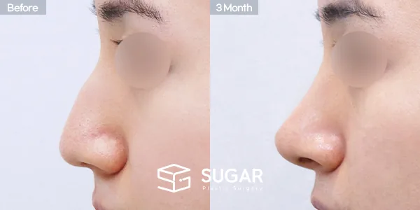 슈가성형외과 첫) 무보형물 + 매부리 + 비중격연장 + 귀 뒤 근막 + 귀연골 전후사진 - 측면 수술 전후 비교