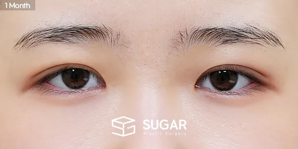 슈가성형외과 첫) 자연유착 + 눈매교정 + 윗트임 + 눈 두덩이 지방 제거 전후사진 - 수술 후