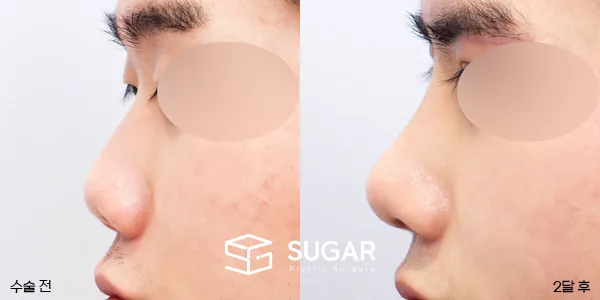 슈가성형외과 첫) 콧대코끝 + 매부리 + 복코 + 절골 + 기증늑 전후사진 - 측면 수술 전후 비교