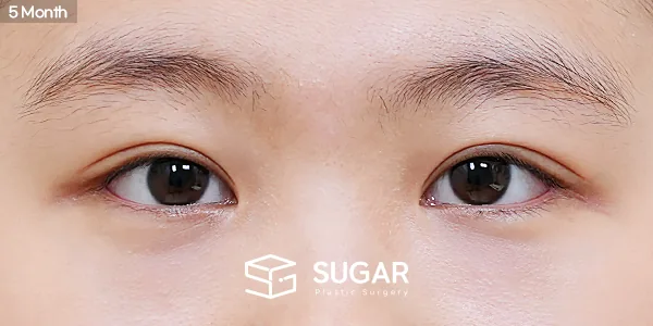 슈가성형외과 재) 재수술 + 절개 + 눈매교정 + 뒤밑트임 전후사진 - 수술 후