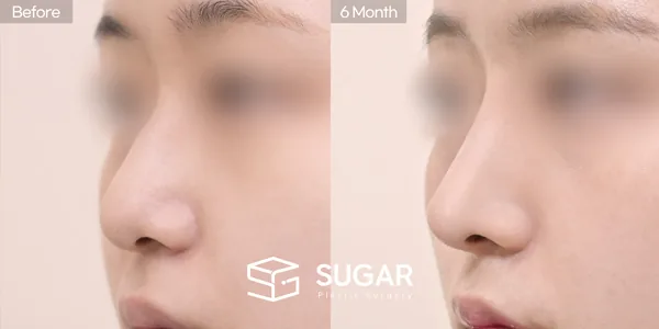 슈가성형외과 첫) 콧대 + 귀연골 + 기증늑 + 메부리 + 복코교정 전후사진 - 45도 수술 전후 비교