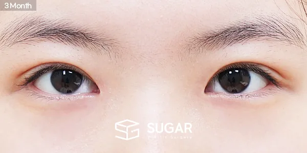 슈가성형외과 첫) 자연유착 + 눈매교정 + 앞트임 전후사진 - 수술 후