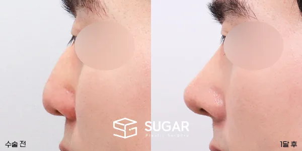 슈가성형외과 첫) 무보형물 + 매부리 + 절골 + 귀 뒤 근막 + 비중격 + 귀연골 전후사진 - 측면 수술 전후 비교