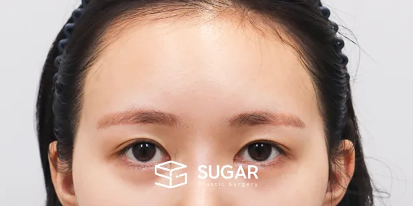 슈가성형외과 재) 이마거상 + 뒷트임 재수술 + 밑트임 + 애교필러 전후사진 - 수술 전