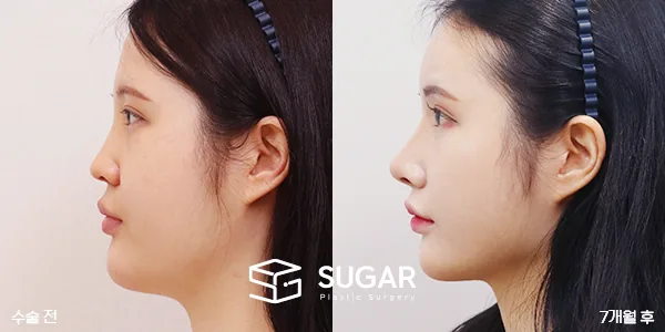 슈가성형외과 첫) 콧대+코끝+절골술+매부리+비중격+이중턱지방흡입 전후사진 - 측면 수술 전후 비교