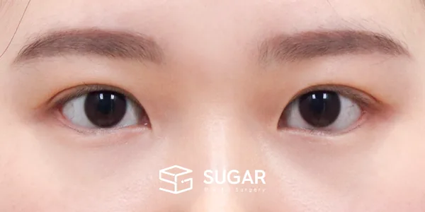 슈가성형외과 첫) 윗트임[R] + 뒤밑트임 전후사진 - 수술 후