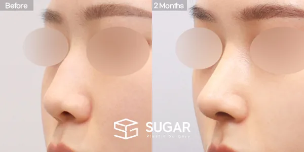 슈가성형외과 첫) 코끝 + 매부리코 + 휜코 + 절골 + 귀연골 + 귀 뒤 근막 전후사진 - 45도 수술 전후 비교