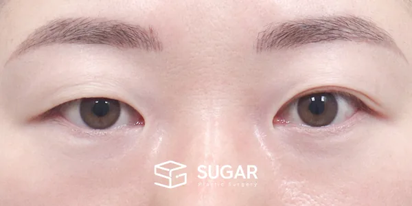 슈가성형외과 첫) 절개 + 윗트임 전후사진 - 수술 전