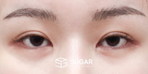 슈가성형외과 첫) 자연유착 + 눈매교정 + 윗트임 전후사진 - 수술 전