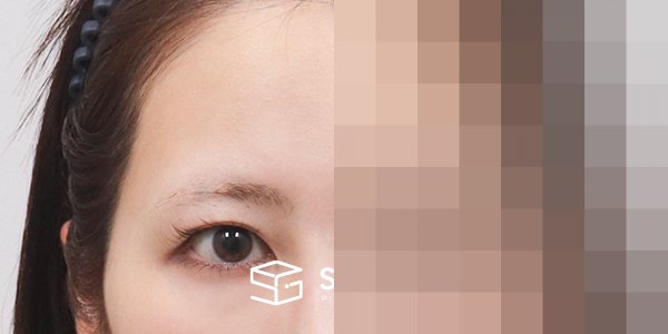 슈가성형외과 재) 이마거상 + 절개 재수술 전후사진 - 정면 수술 전후 비교