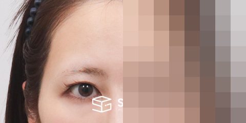 슈가성형외과 재) 이마거상 + 절개 재수술 전후사진 - 정면 수술 전후 비교
