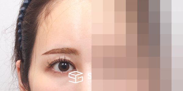 슈가성형외과 재) 이마거상 + 절개 재수술 전후사진 - 45도 수술 전후 비교