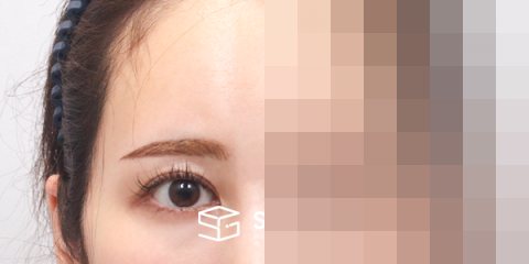 슈가성형외과 재) 이마거상 + 절개 재수술 전후사진 - 45도 수술 전후 비교