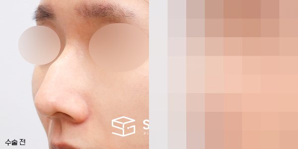 슈가성형외과 첫) 콧대코끝 + 매부리 + 휜코 + 비주 내리기 + 콧볼축소 + 비중격 전후사진 - 정면 수술 전후 비교
