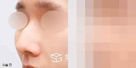 슈가성형외과 첫) 콧대코끝 + 매부리 + 휜코 + 비주 내리기 + 콧볼축소 + 비중격 전후사진 - 정면 수술 전후 비교
