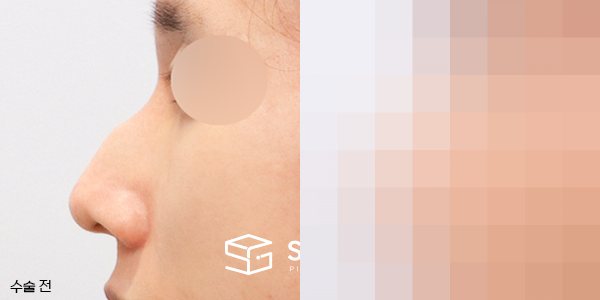 슈가성형외과 첫) 콧대코끝 + 매부리 + 휜코 + 비주 내리기 + 콧볼축소 + 비중격 전후사진 - 45도 수술 전후 비교