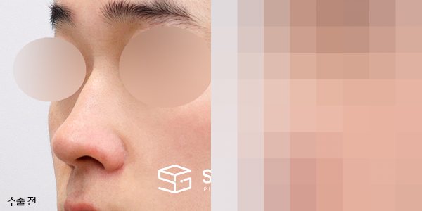 슈가성형외과 첫) 콧대코끝 + 매부리 + 콧볼축소 + 귀연골 전후사진 - 정면 수술 전후 비교