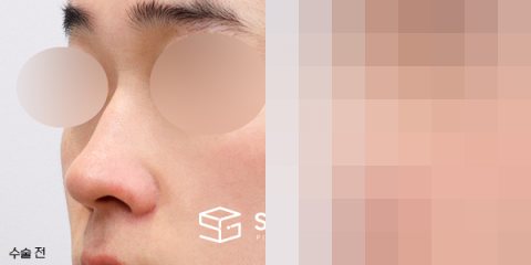 슈가성형외과 첫) 콧대코끝 + 매부리 + 콧볼축소 + 귀연골 전후사진 - 정면 수술 전후 비교