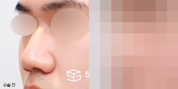 슈가성형외과 첫) 무보형물 + 매부리 + 복코 + 비주 지지 + 근막 + 비중격 + 귀연골 전후사진 - 정면 수술 전후 비교