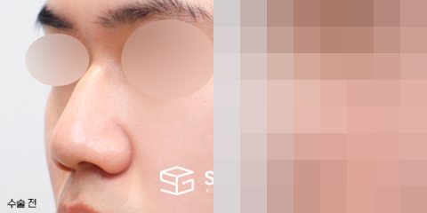 슈가성형외과 첫) 무보형물 + 매부리 + 복코 + 비주 지지 + 근막 + 비중격 + 귀연골 전후사진 - 정면 수술 전후 비교
