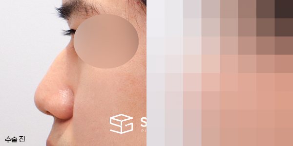 슈가성형외과 첫) 무보형물 + 매부리 + 복코 + 비주 지지 + 근막 + 비중격 + 귀연골 전후사진 - 45도 수술 전후 비교