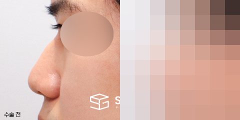 슈가성형외과 첫) 무보형물 + 매부리 + 복코 + 비주 지지 + 근막 + 비중격 + 귀연골 전후사진 - 45도 수술 전후 비교