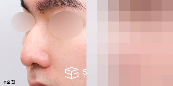 슈가성형외과 첫) 무보형물 + 매부리 + 절골 + 귀 뒤 근막 + 비중격 + 귀연골 전후사진 - 정면 수술 전후 비교