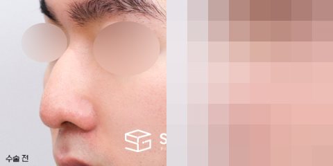 슈가성형외과 첫) 무보형물 + 매부리 + 절골 + 귀 뒤 근막 + 비중격 + 귀연골 전후사진 - 정면 수술 전후 비교