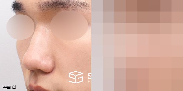 슈가성형외과 재) 코재수술 + 매부리 + 복코 + 기증늑 전후사진 - 정면 수술 전후 비교