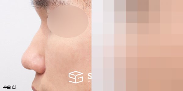 슈가성형외과 재) 코재수술 + 매부리 + 복코 + 기증늑 전후사진 - 45도 수술 전후 비교
